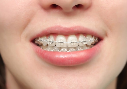 Braces Close Up - Midwest Orthodontics Center