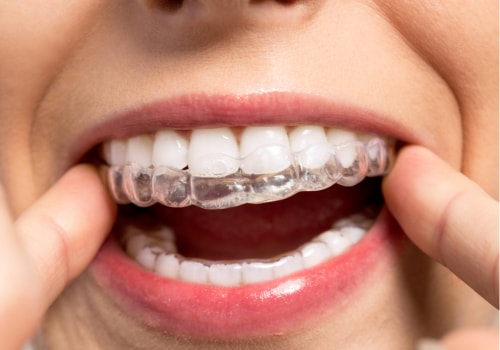 invisible braces in Chicago 60625