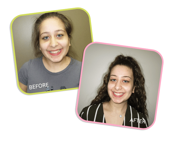 Before and After Smile - Tina