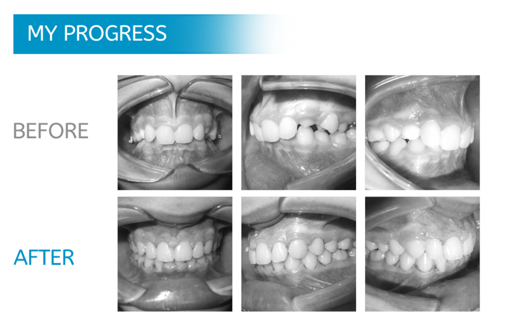 Midwest Orthodontics Chicago: Braces - Before and After Dental X-Rays