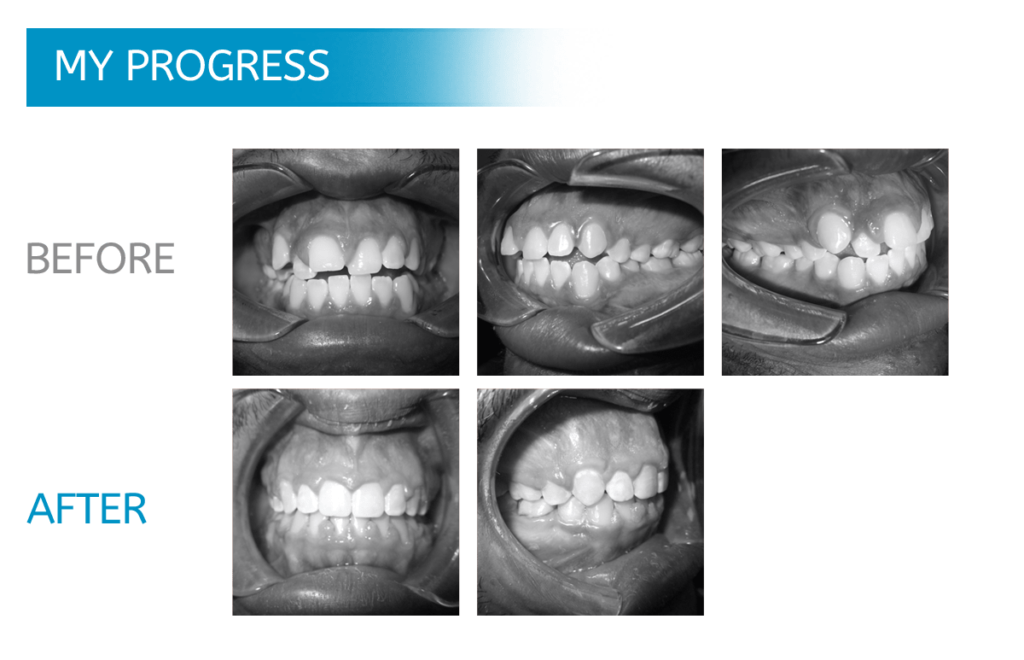 Braces in Chicago: Before and After Dental X-Rays