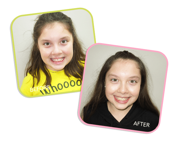 Chicago Orthodontics - Camilla Before and After Image