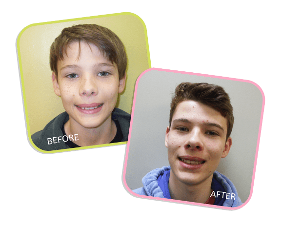 Chicago Orthodontics - Gabriel Before and After Image
