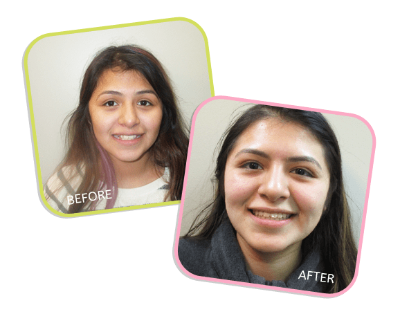Chicago Orthodontics -Sarahi Before and After Image