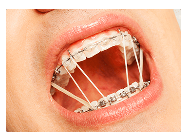 orthodontic services - temporary anchorage