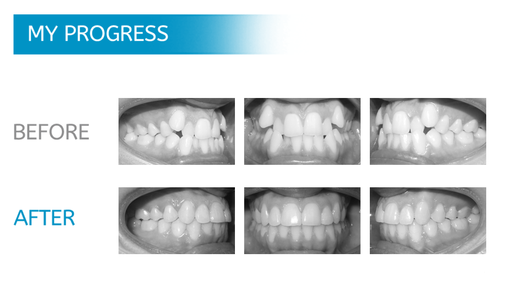 Chicago Orthodontics - Dental X-Rays Before and After Braces