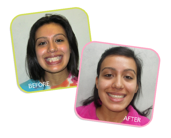 Chicago Orthodontics - Before and After Image